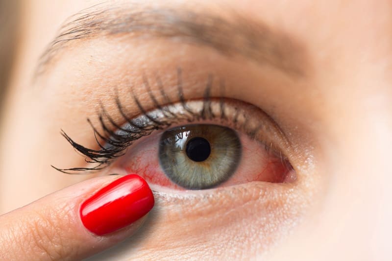 Terapia térmica para rosácea ocular
