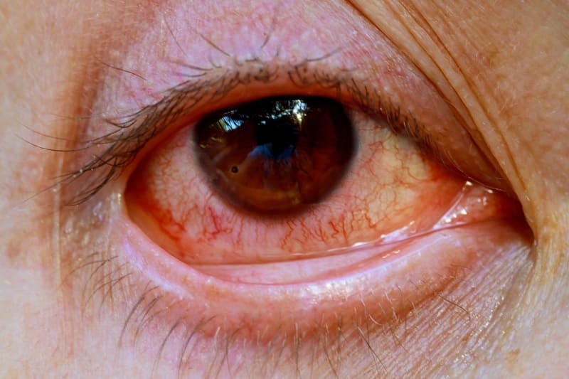 Tratamiento de conjuntivitis alérgica en San Ángel, CDMX