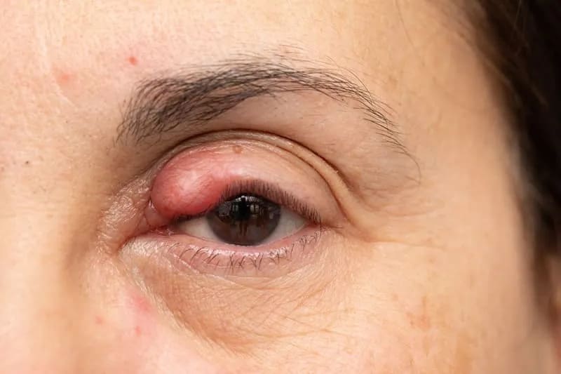 Tratamiento de infecciones oculares